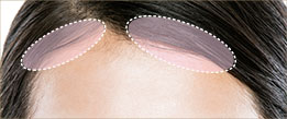Hair transplant