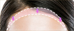 Forehead reduction