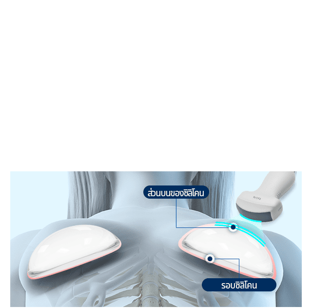 Capsule From Implant Through Full HD Ultrasound