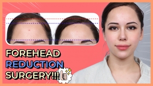 My forehead reduction surgery at DA Clinic (Tobin Vlog)